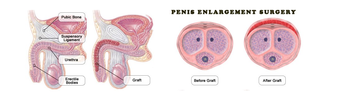 Surgery To Enlarge Penis 11
